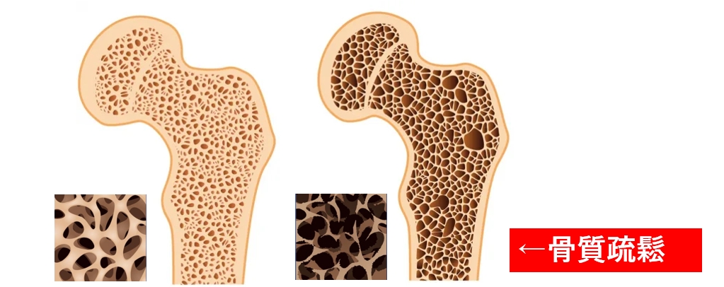Healthtalk / 骨質疏鬆症